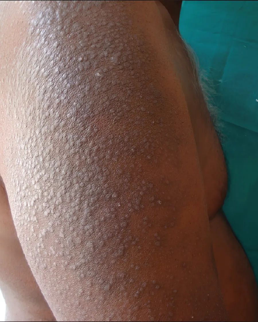 Advanced Eczema Care at Cinch Clinics